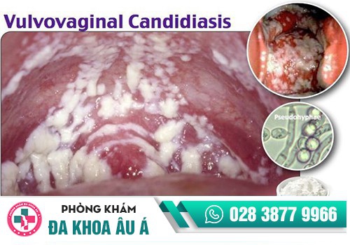 Sưng vùng kín do nấm âm đạo